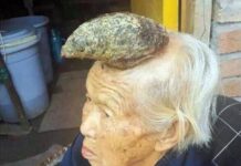 Cutaneous Horn: The Bizarre Skin Tumor